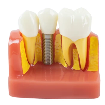 Усовершенствованная модель стоматологического исследования со съемными зубами, модель для анализа имплантатов, демонстрации коронок и мостовидных протезов - идеально подходит для стоматологов